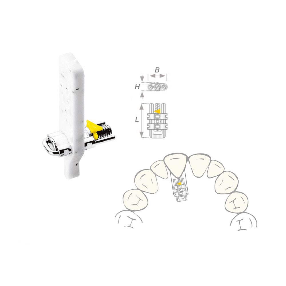 Dehnschraube Vector 350 micro, 10 Stück