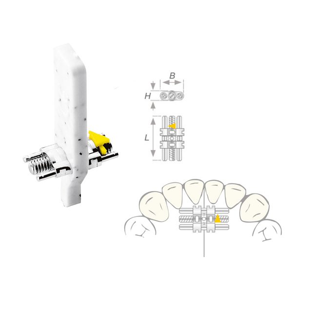 Dehnschraube Vector 050 micro, 10 Stück