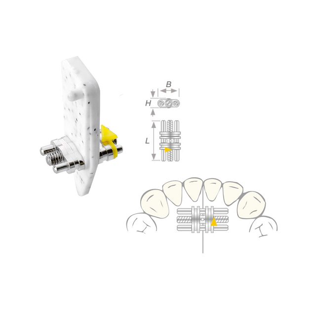 Dehnschraube Vector 100 mini, 10 Stück