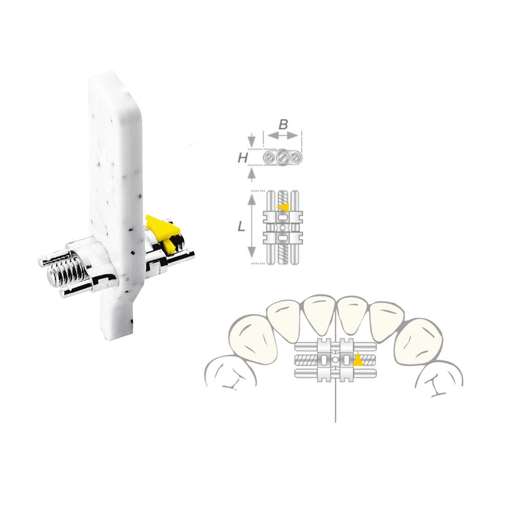 Dehnschraube Vector 050 micro, 10 Stück